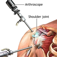 Arthroscopic surgery