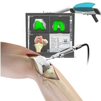Computer-navigated joint replacement