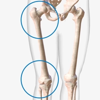 Knee and hip replacement
