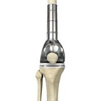 Limb salvage surgery for bone tumors